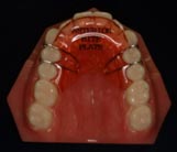 Types Of Appliances - Bibby Orthodontics | Nelson Bc