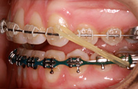 Types Of Appliances Bibby Orthodontics Nelson Bc